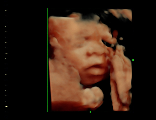 3D ultrasound image at 28 weeks